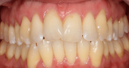 Antes — Caso 1 Invisalign