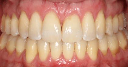 Depois — Caso 1 Invisalign