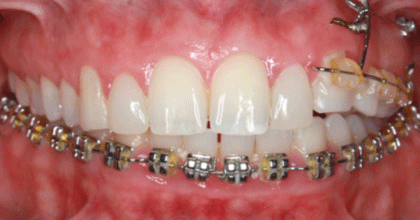 Antes — Caso 3 Invisalign Retratamento