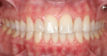 Depois — Caso 3 Invisalign Retratamento