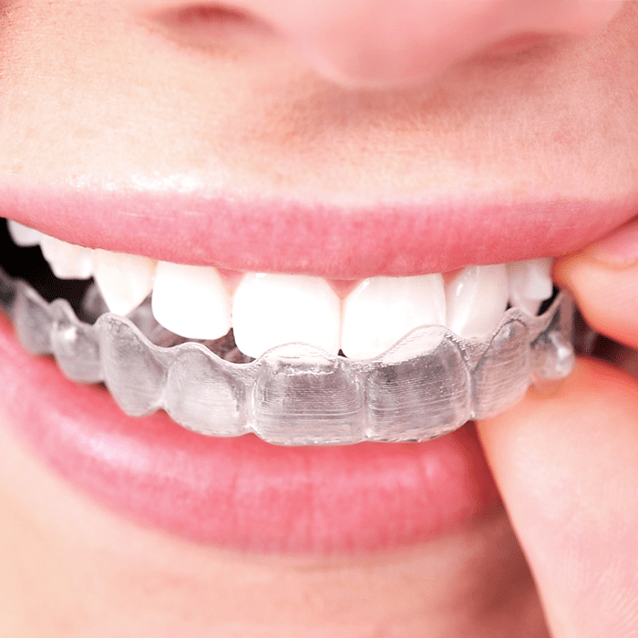 Alinhador Invisalign transparente